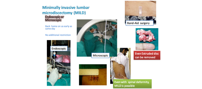 Percutaneous